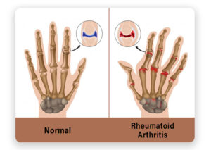 Normal Rheumatoid Arthritis