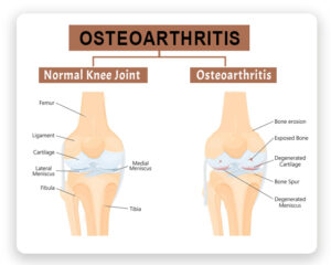 Osteoarthritis